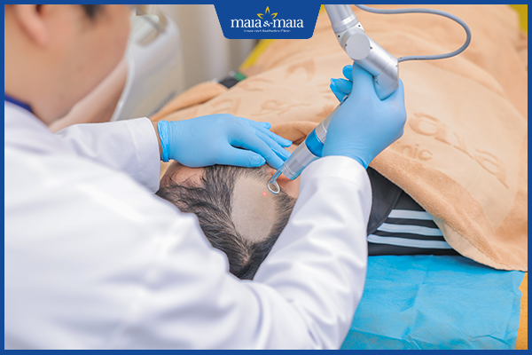 trị rụng tóc nam tại maia
