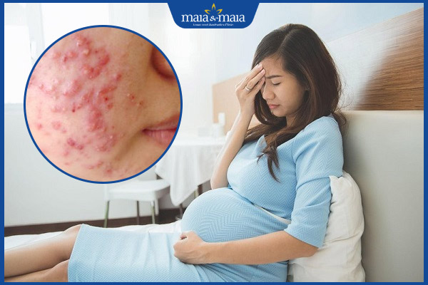 trứng cá nặng khi mang thai
