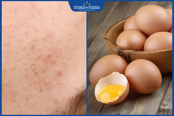 trứng gà trị mụn ẩn