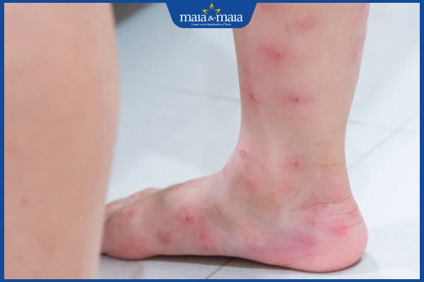viêm da chân gây mụn nước