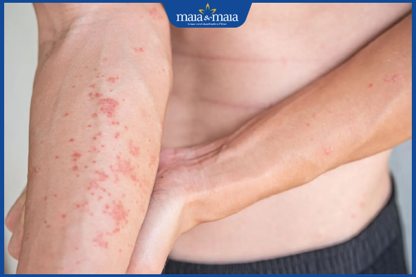 viêm da gây mụn nước