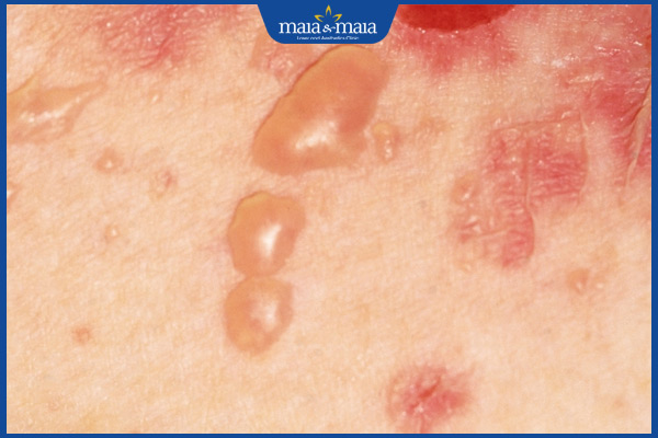 bệnh pemphigus mụn nước