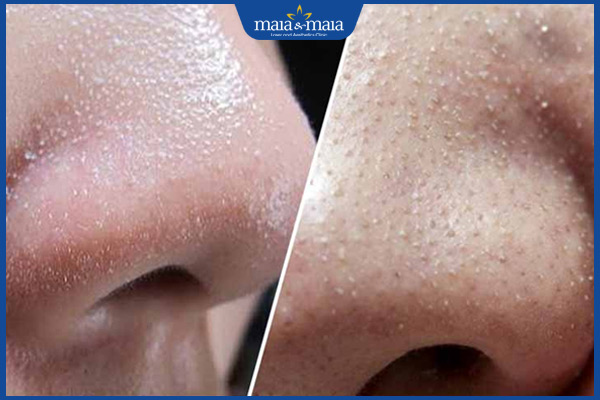 biểu hiện của mụn cám