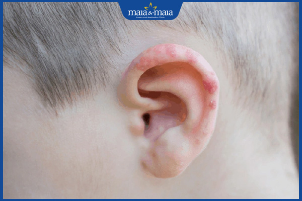 biểu hiện mụn nước ở tai