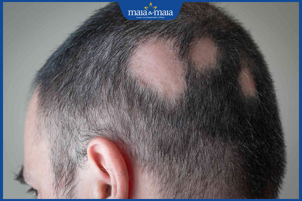 biểu hiện rụng tóc