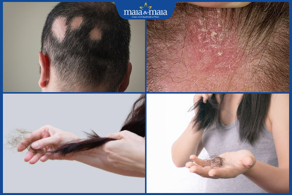các loại rụng tóc