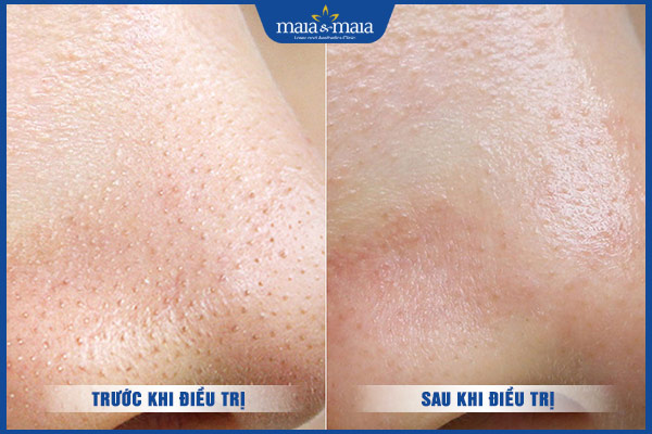 công nghệ loại bỏ mụn