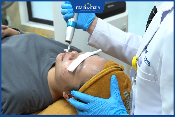 công nghệ trị mụn bọc