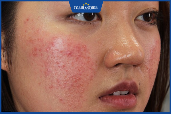 dị ứng mỹ phẩm