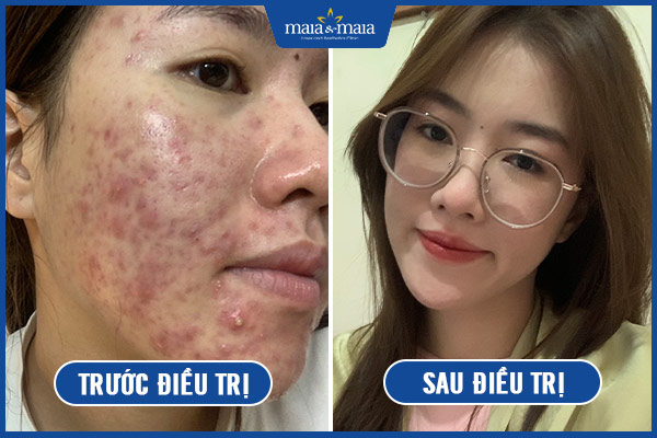 điều trị mụn bọc tại maia