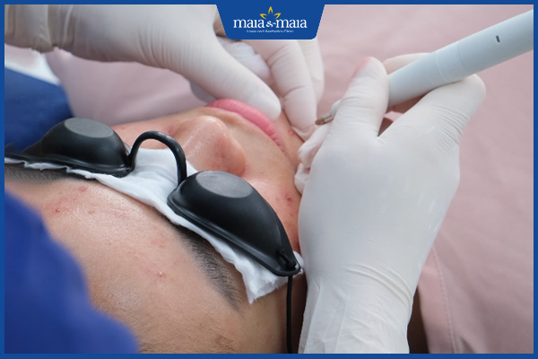 điều trị mụn công nghệ cao