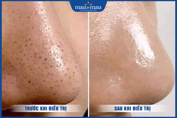 điều trị sạch mụn