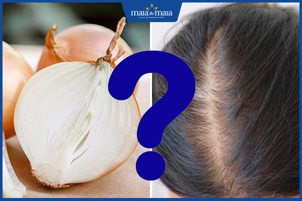 hành tây trị rụng tóc