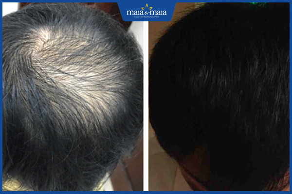 hiệu quả maitrix hair