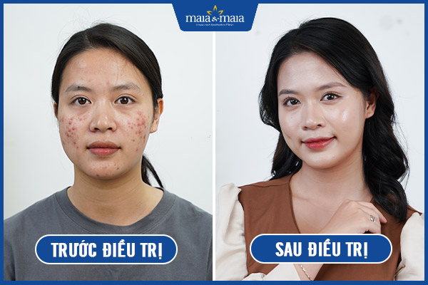 hiệu quả sau trị mụn