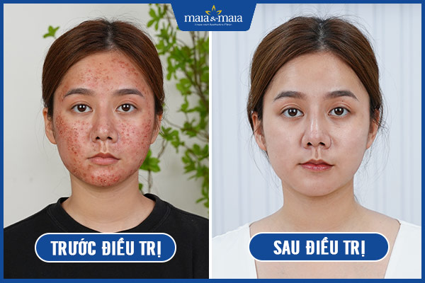 hiệu quả trị mụn maia