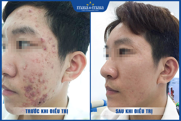 hiệu quả trị mụn viêm maia