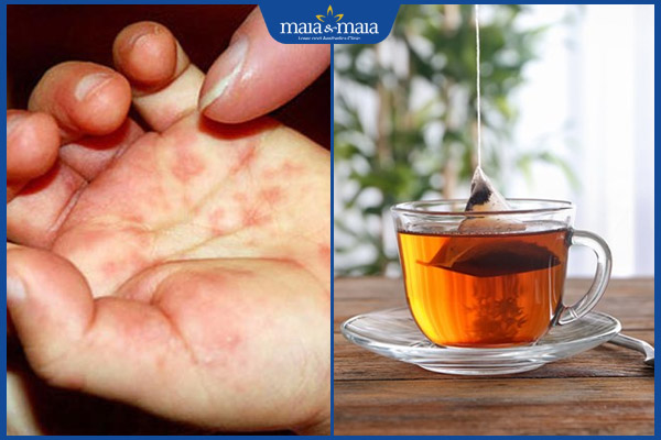 hồng trà trị mụn nước tay