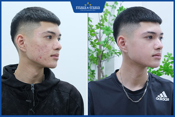 kết quả sau khi trị mụn