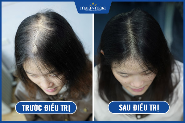 kết quả sau trị rụng tóc maia
