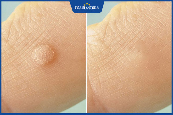 kết quả trị hạt cơm maia