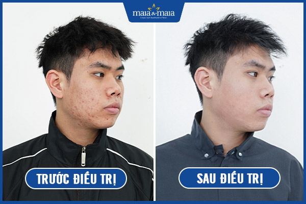 kết quả trị mụn maia