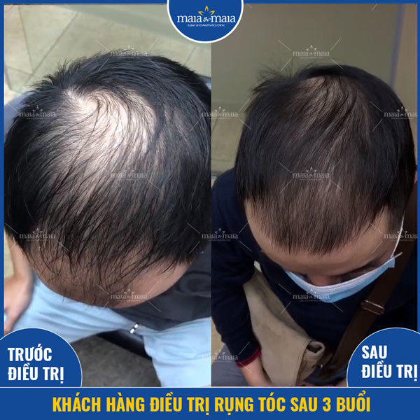 khách chữa rụng tóc