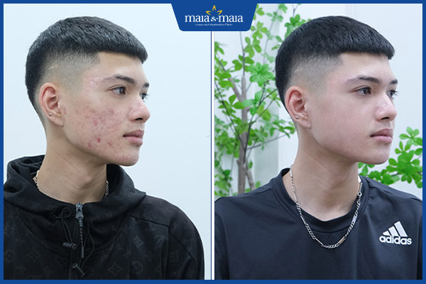 khách hàng sau điều trị mụn