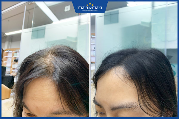 khách trị rụng tóc maia