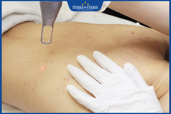 laser trị mụn ẩn ở lưng