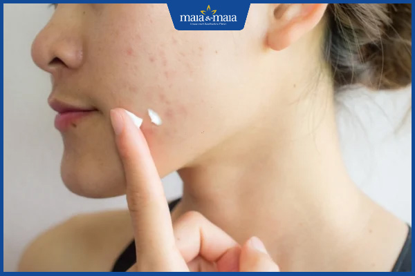 lựa chọn kem trị mụn