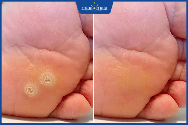 maia trị hạt cơm dứt điểm
