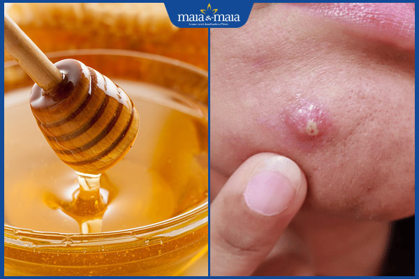 mật ong trị mụn mủ