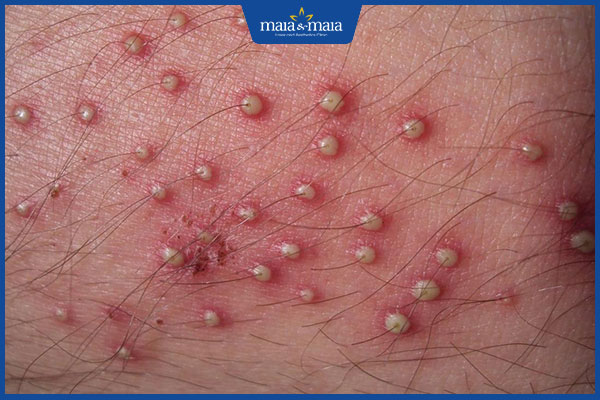 Mụn hạt cơm: Dấu hiệu nhận biết và cách điều trị an toàn, hiệu quả 6 mụn hạt cơm sinh dục