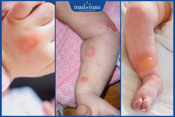 mụn nước khắp người trẻ