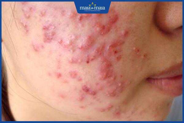 mụn trứng cá đỏ trên mặt