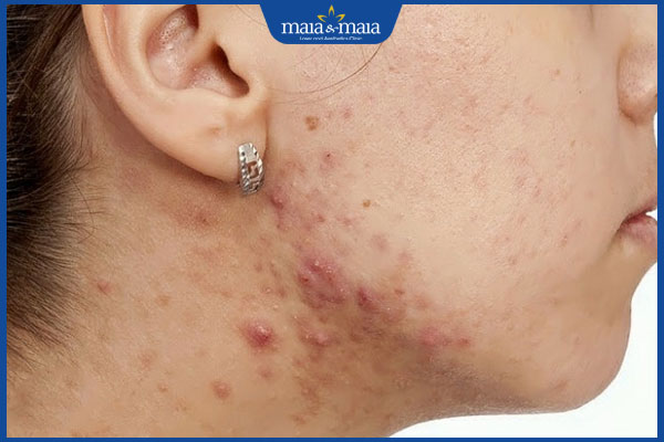 mụn trứng cá vùng cổ