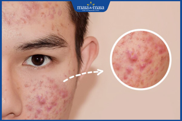 mụn viêm tự hết