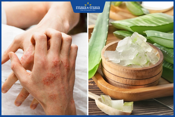 nha đam trị mụn nước tay