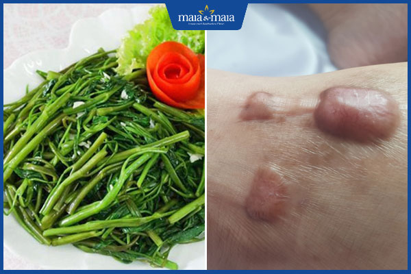 rau muống gây sẹo lồi