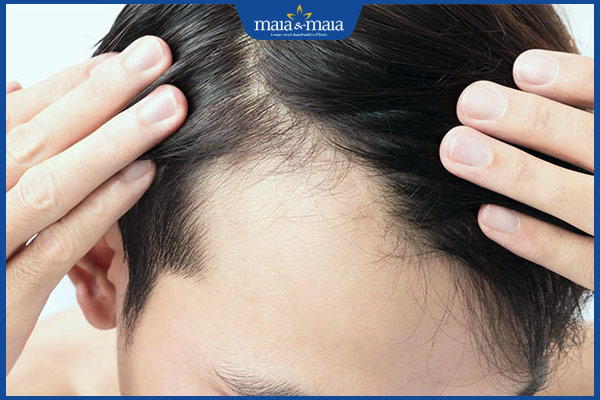 rụng tóc nam tuổi dậy thì