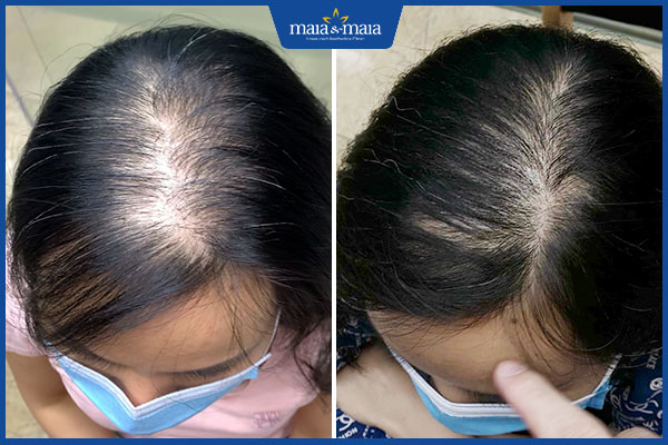 sau điều trị rụng tóc
