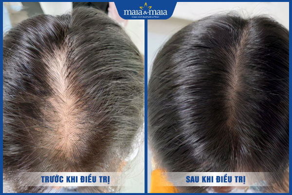 sau khi trị rụng tóc tại maia