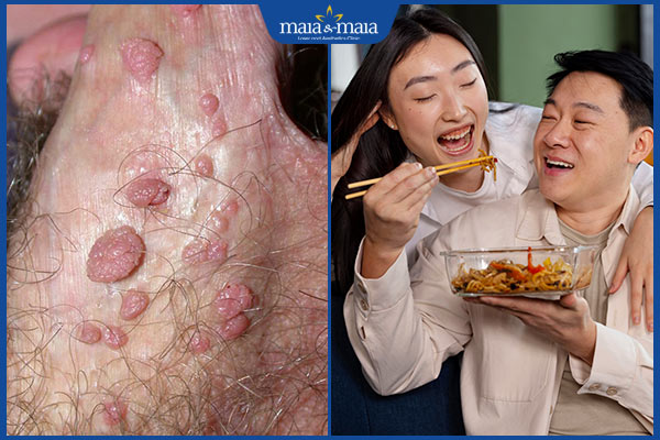 sùi mào gà lây qua đường ăn uống
