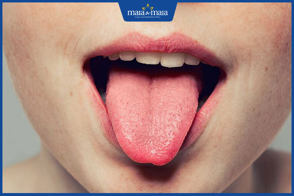 sùi mào gà ở lưỡi phụ nữ
