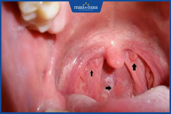 Sùi mào gà ở nữ: Nguyên nhân, dấu hiệu và cách điều trị 3 sùi mào gà ở vòm họng
