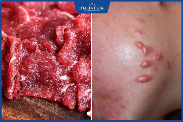 thịt bò gây sẹo lồi