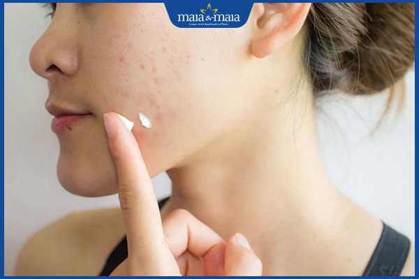 thoa kem trị mụn trứng cá