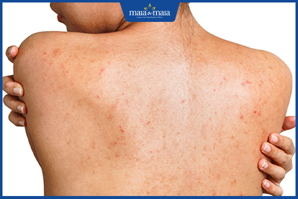 tình trạng mụn ẩn ở lưng