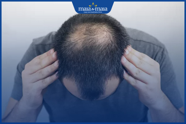 tóc thưa ở xoáy đầu